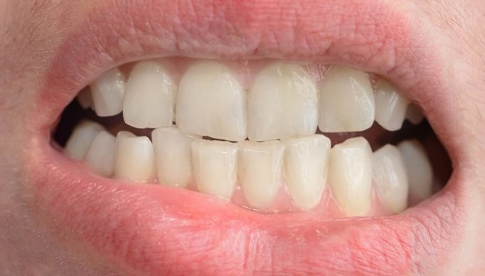 Além-da-estética-dentes-tortos-podem-afetar-sua-saúde