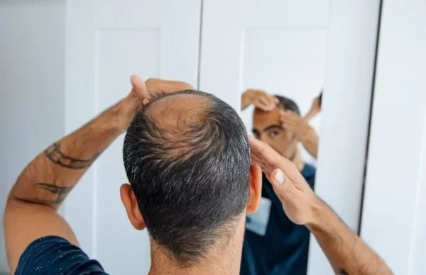 Calvicie-600x400