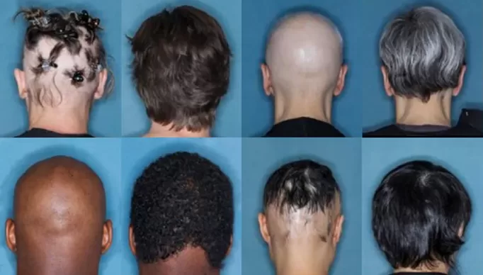 ynews-alopecia-1