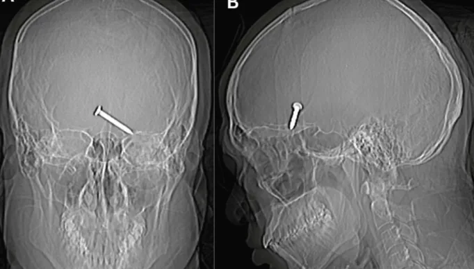 Raio-x-pistola-de-pregos-compressed-scaled