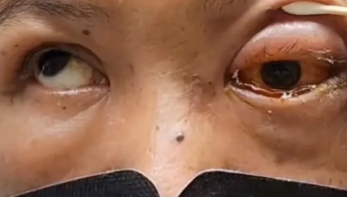 Homem-fica-cego-apos-dormir-de-brucos