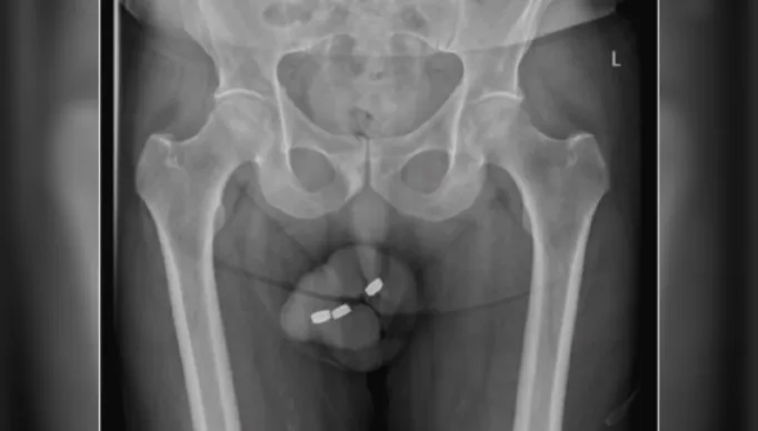 Idoso-coloca-baterias-na-uretra-penis-tictac