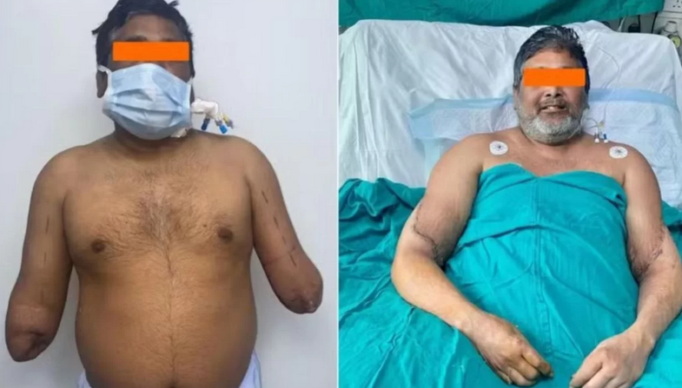 Screenshot 2024-03-07 at 13-27-12 Indiano recupera as mãos após transplante de alta complexidade